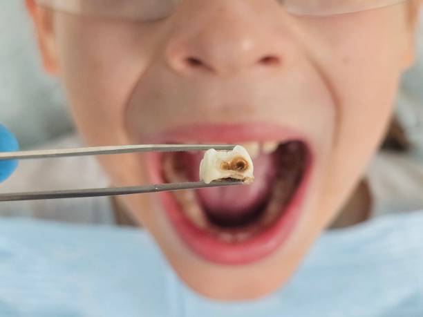 Best Emergency Gum Treatment in North Spearfish, SD